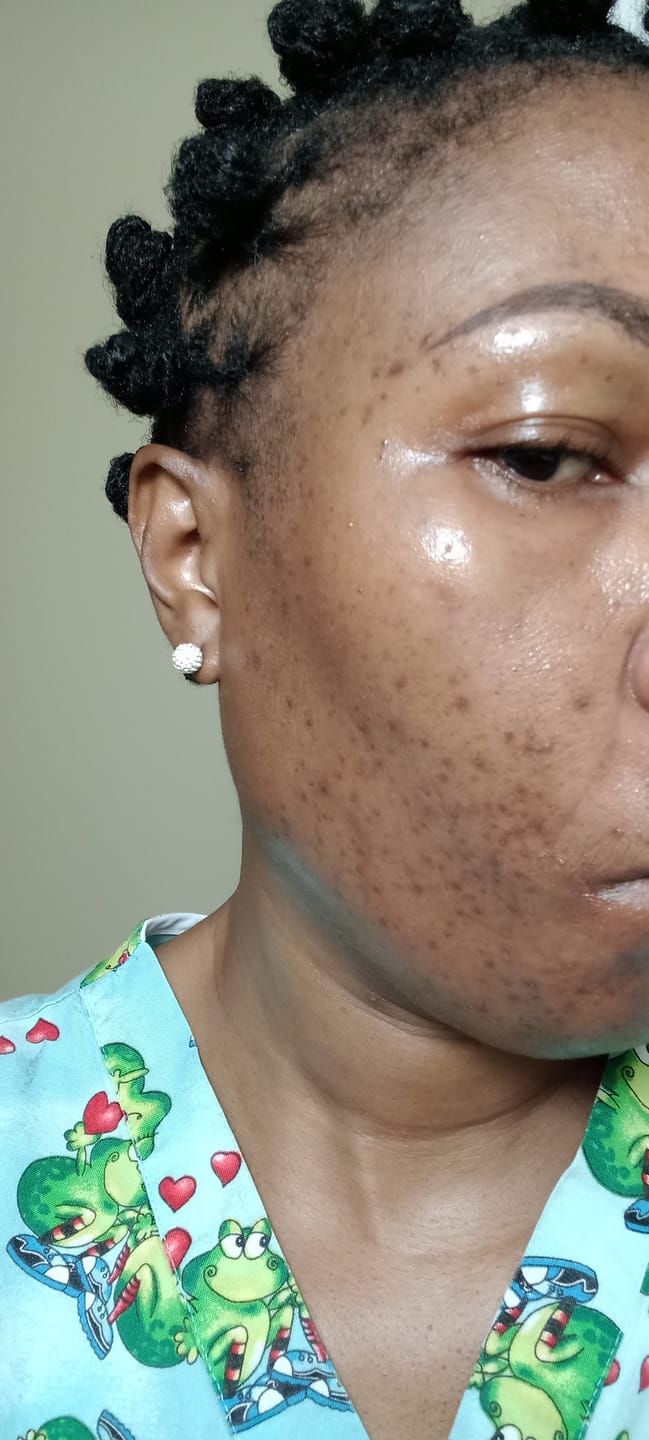Customer photo review of Dark spot serum