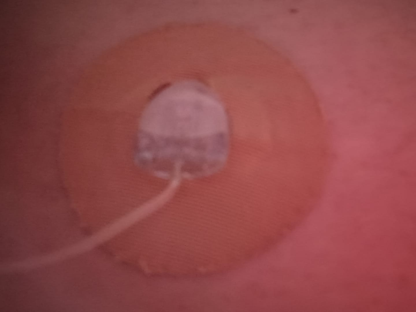 Customer photo review of Skin Grip Original - Universal Adhesive Patches (0.8 inch Hole)