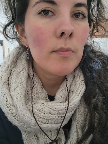 Customer photo review of Kit Antiacné