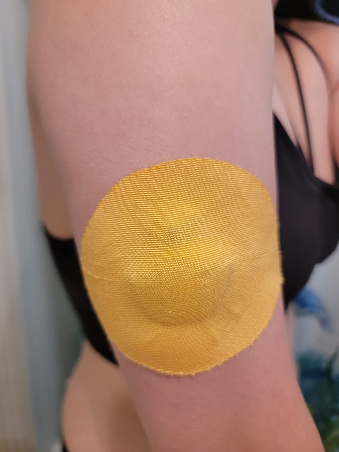 Customer photo review of Skin Grip Original - Medtronic Guardian/Enlite Adhesive Patches