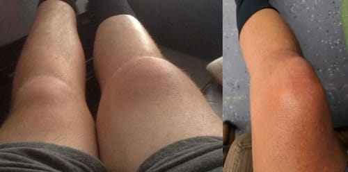 Customer photo review of (🔥LAST DAY SALE-80% OFF)MOONBIFFY™ Joint & Bone Therapy Bee Venom Treatment Gel