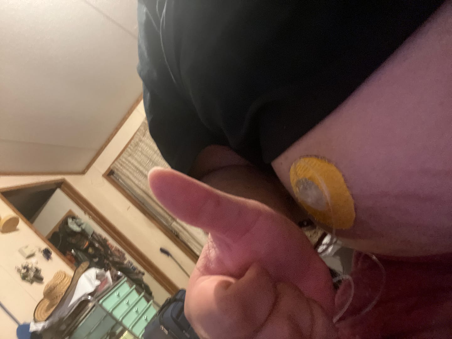 Customer photo review of Skin Grip Original - Universal Adhesive Patches (0.8 inch Hole)