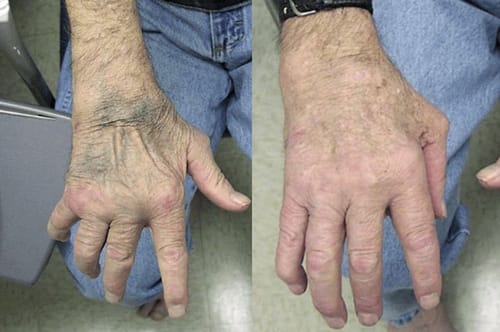 Customer photo review of (🔥LAST DAY SALE-80% OFF)MOONBIFFY™ Joint & Bone Therapy Bee Venom Treatment Gel