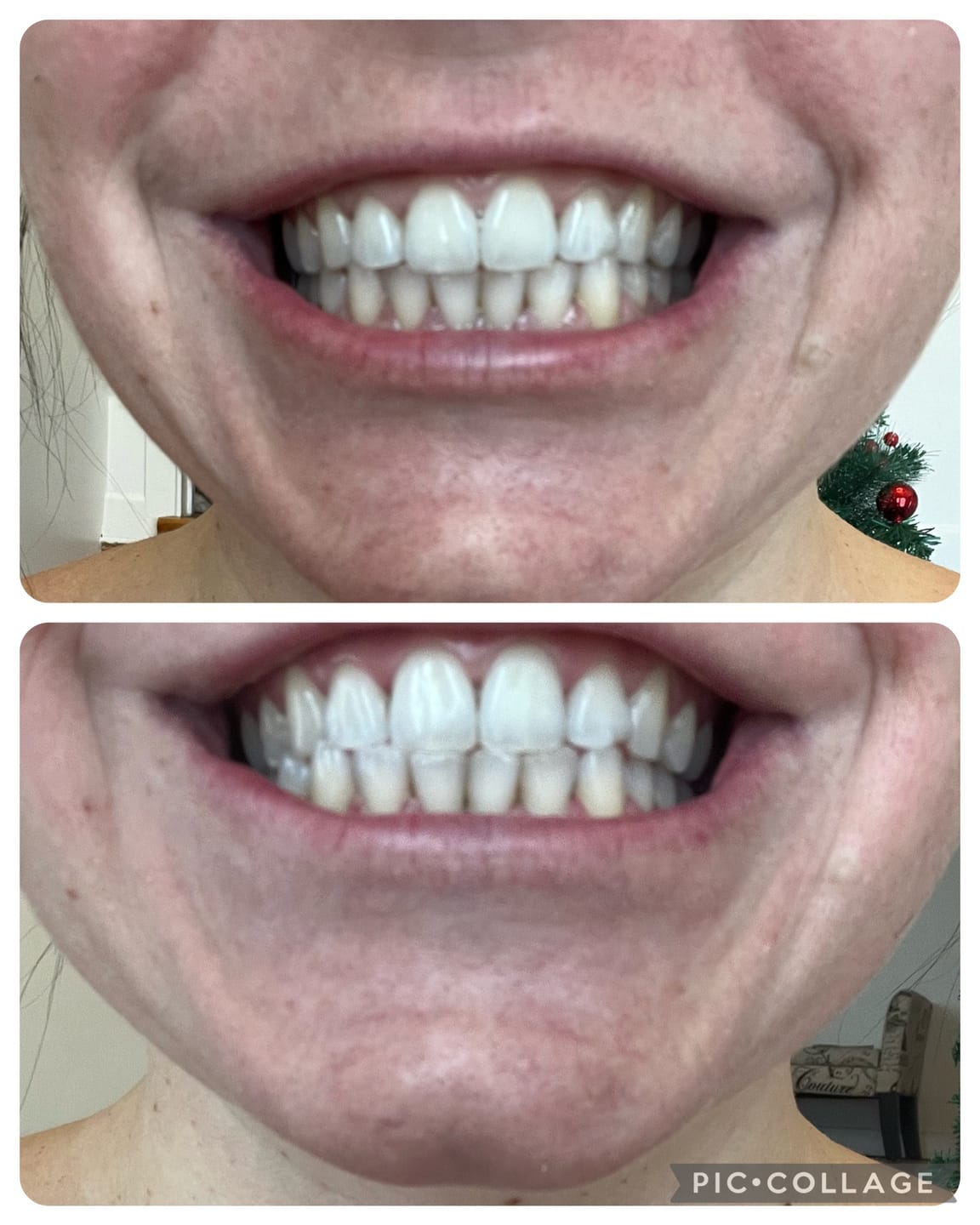 Customer photo review of Le Pack Ultime : Gel Violet + Bandes Blanchissantes