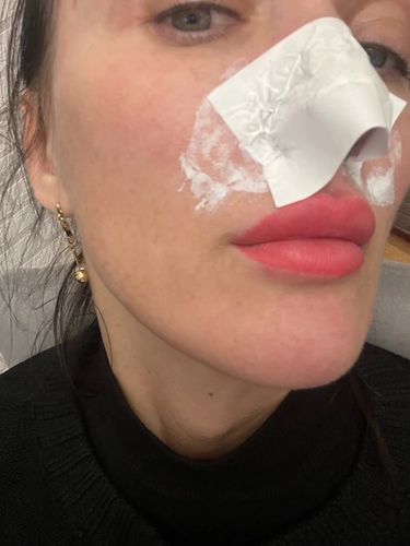 Customer photo review of Masque anti points noirs + 60 bandes offertes