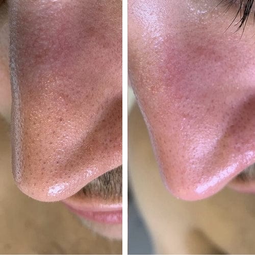 Customer photo review of Masque anti points noirs + 60 bandes offertes