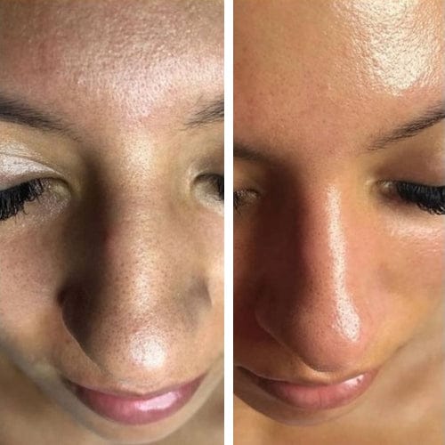 Customer photo review of Masque anti points noirs + 60 bandes offertes