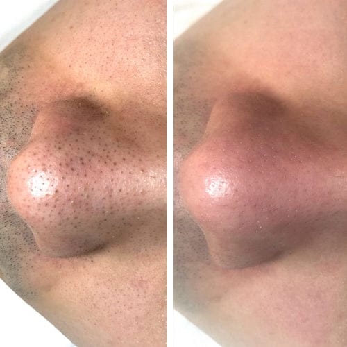 Customer photo review of Masque anti points noirs + 60 bandes offertes