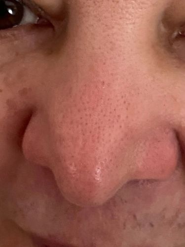 Customer photo review of Masque anti points noirs + 60 bandes offertes