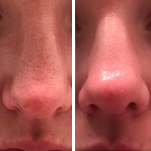 Customer photo review of Masque anti points noirs + 60 bandes offertes