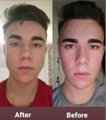 Customer photo review of JAWLINER® 3.0 Expert