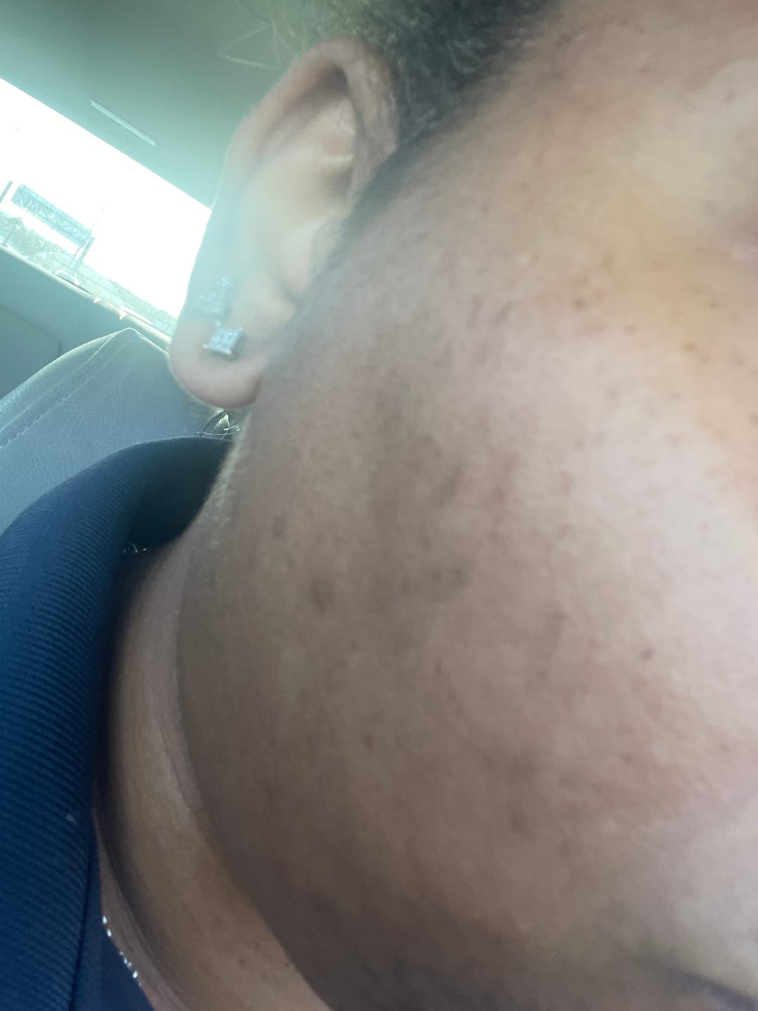 Customer photo review of Magic Eraser Dark Spot Cream