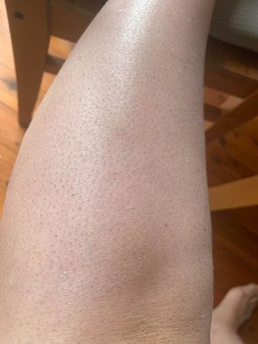 Customer photo review of Aura Skin - Laser Haarentferner