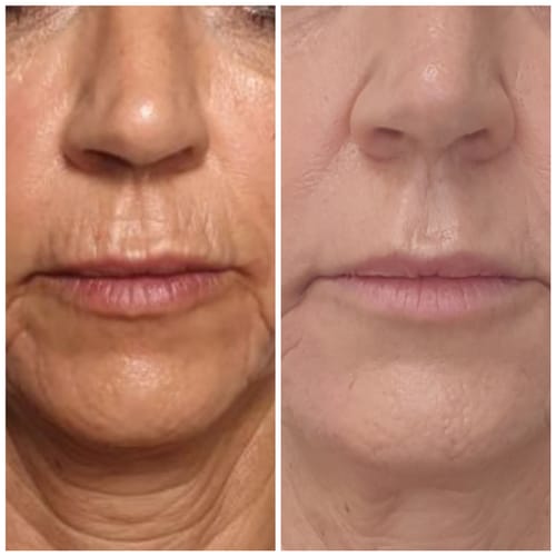 Customer photo review of Masque Coréen au Collagène Invisible (Yeux)