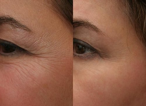 Customer photo review of Masque Coréen au Collagène Invisible (Yeux)