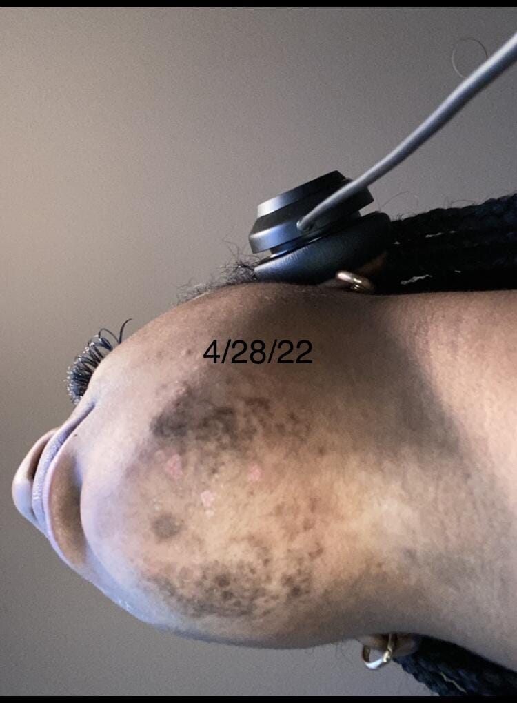 Customer photo review of Fade Cream (Fade Dark Marks)