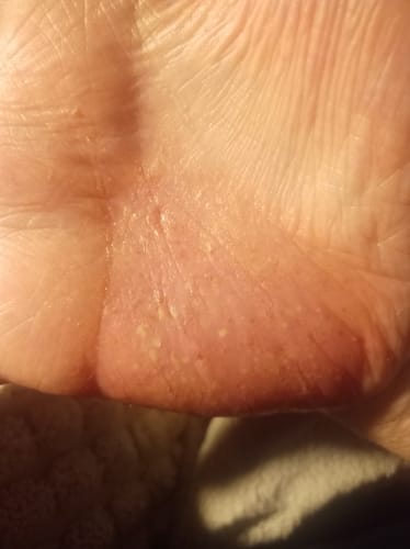 Customer photo review of Psoralyn - pikkelysömör elleni krém