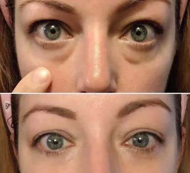 Customer photo review of Glow up Glasses - Augenringe Entferner