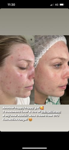 Customer photo review of Intermediate Acne Program™