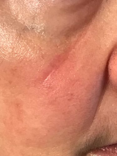 Customer photo review of Scar Gel