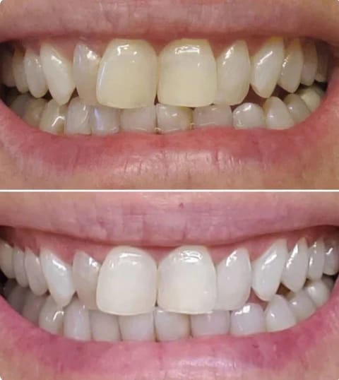Customer photo review of LYSS 405nm sada na bielenie zubov