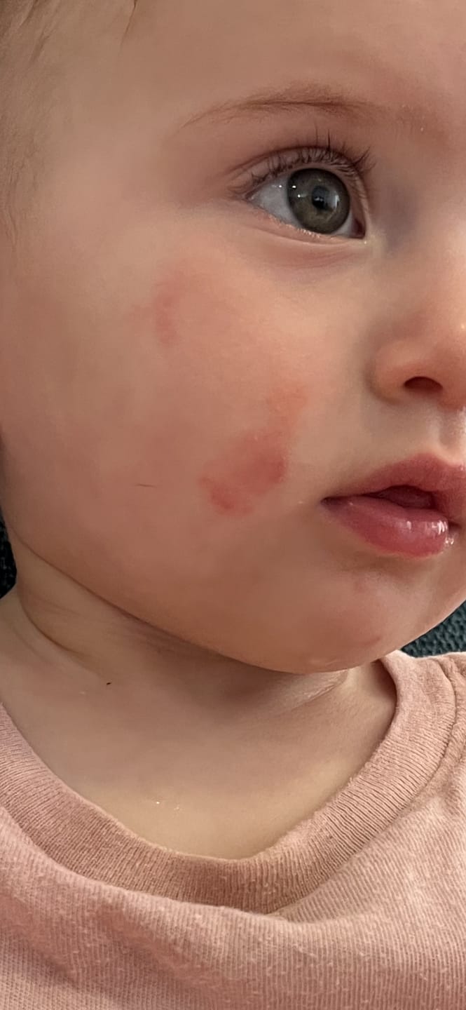 Customer photo review of קרם הרגעה והקלה בגירוי העור- פורטה- פתרון לגירויים, יובש או אדמומיות מכף רגל ועד ראש