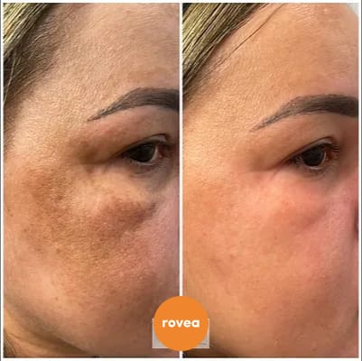 Customer photo review of Sérum Niacinamide Anti taches et acné