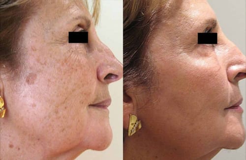 Customer photo review of Sérum Niacinamide Anti taches et acné