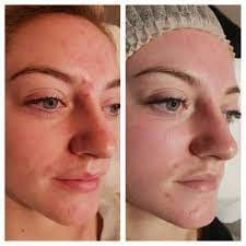 Customer photo review of Sérum Niacinamide Anti taches et acné