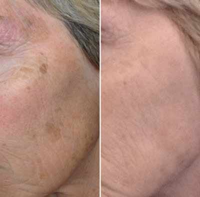 Customer photo review of Sérum Niacinamide Anti taches et acné