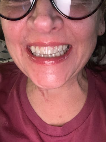 Customer photo review of Premium Upper and Lower Retainer Set