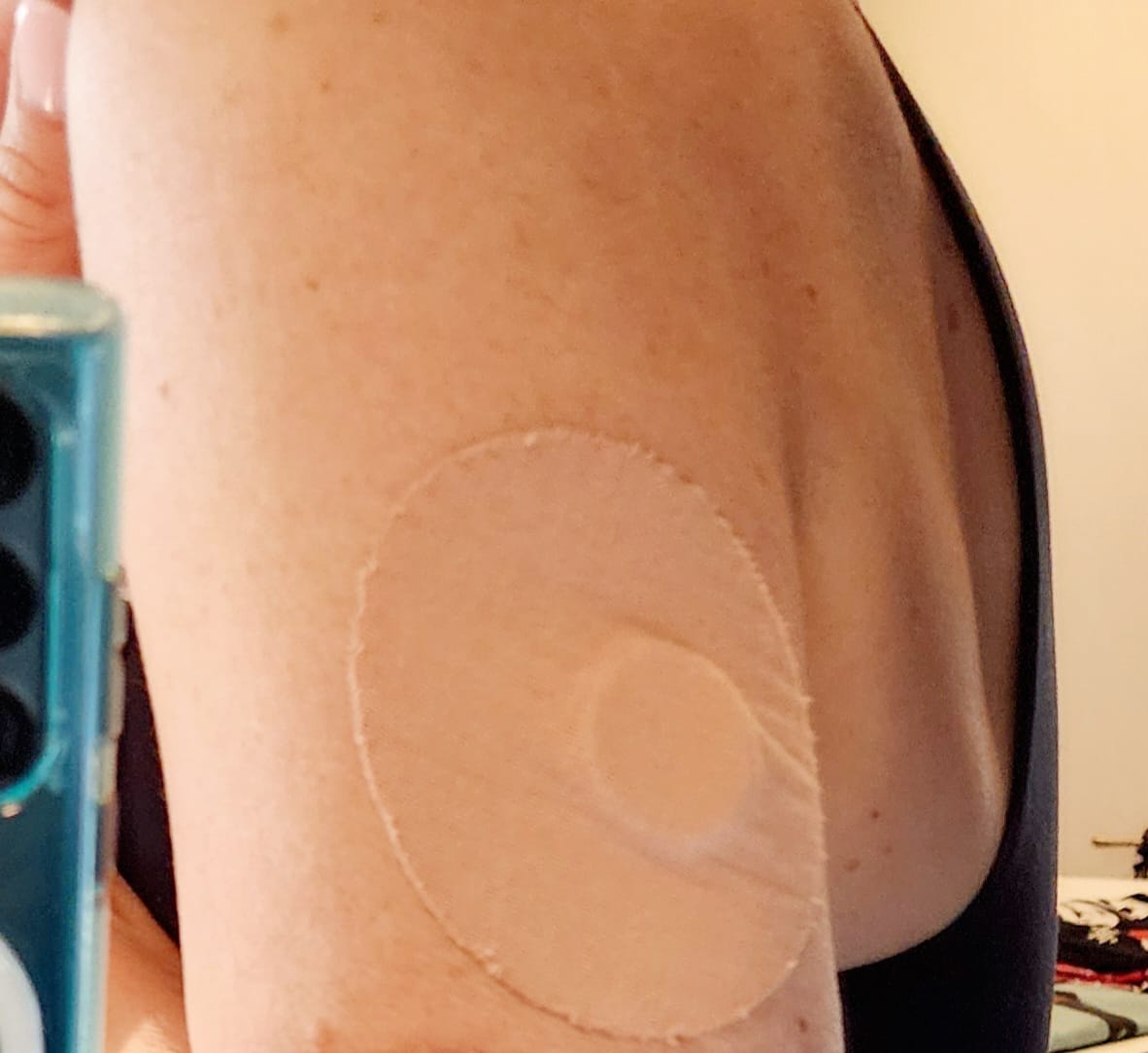 Customer photo review of Skin Grip Original - Freestyle Libre Adhesive Patches
