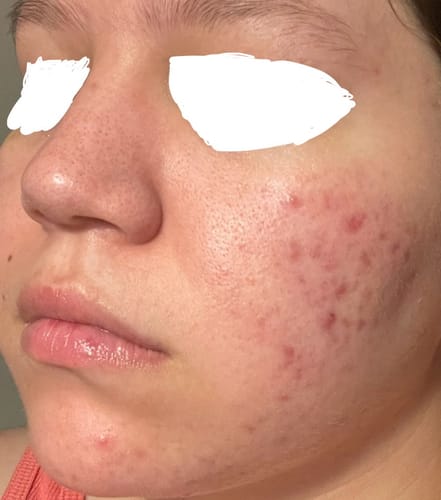 Customer photo review of Niacid