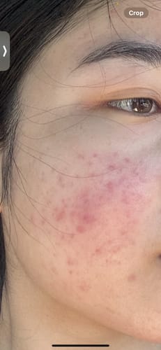 Customer photo review of Intermediate Acne Program™