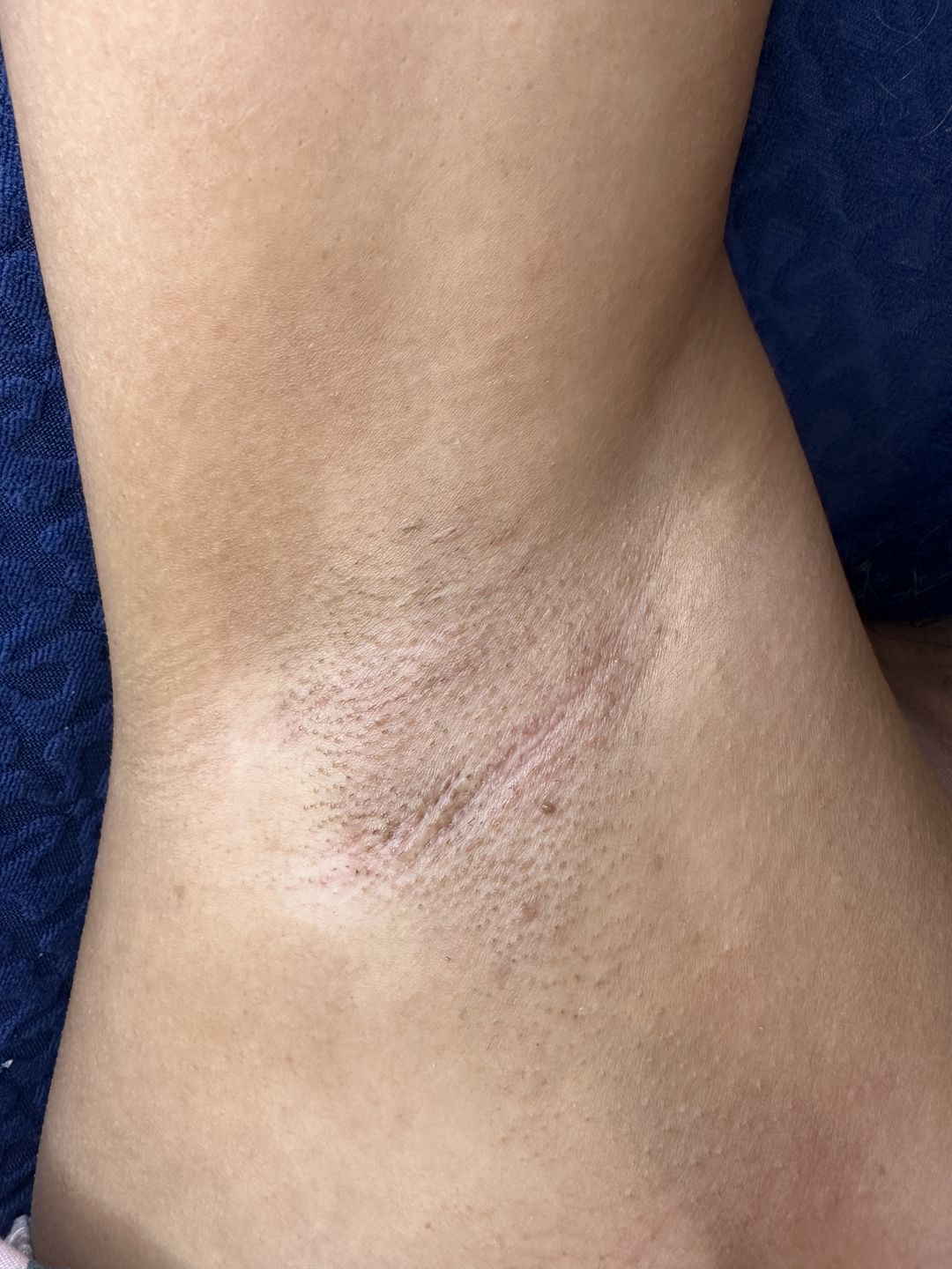 Customer photo review of Pro Series Hair Removal Wax