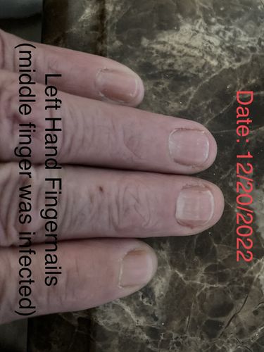 Customer photo review of Onychom - Antifungal Laser Device