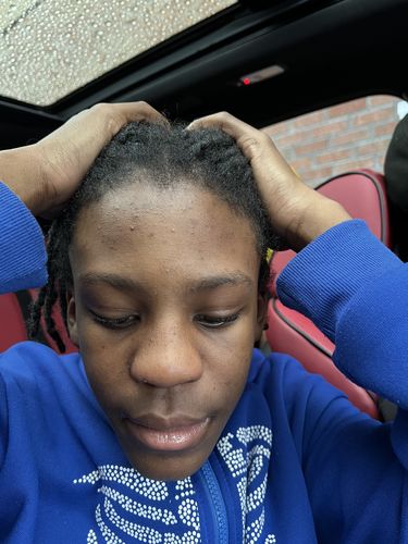 Customer photo review of BERRI-CLEAR+ 5 BERRY SUPERFRUIT SERUM