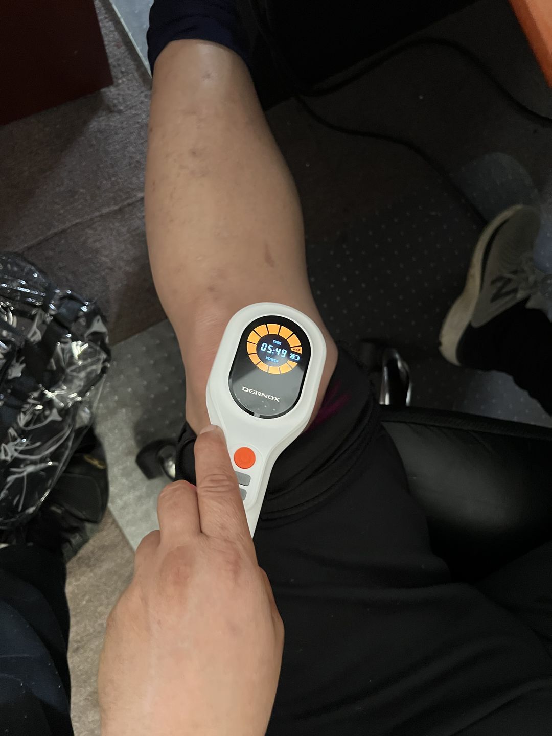 Customer photo review of DERNOX™ Handheld Pain Relief Cold Laser Device