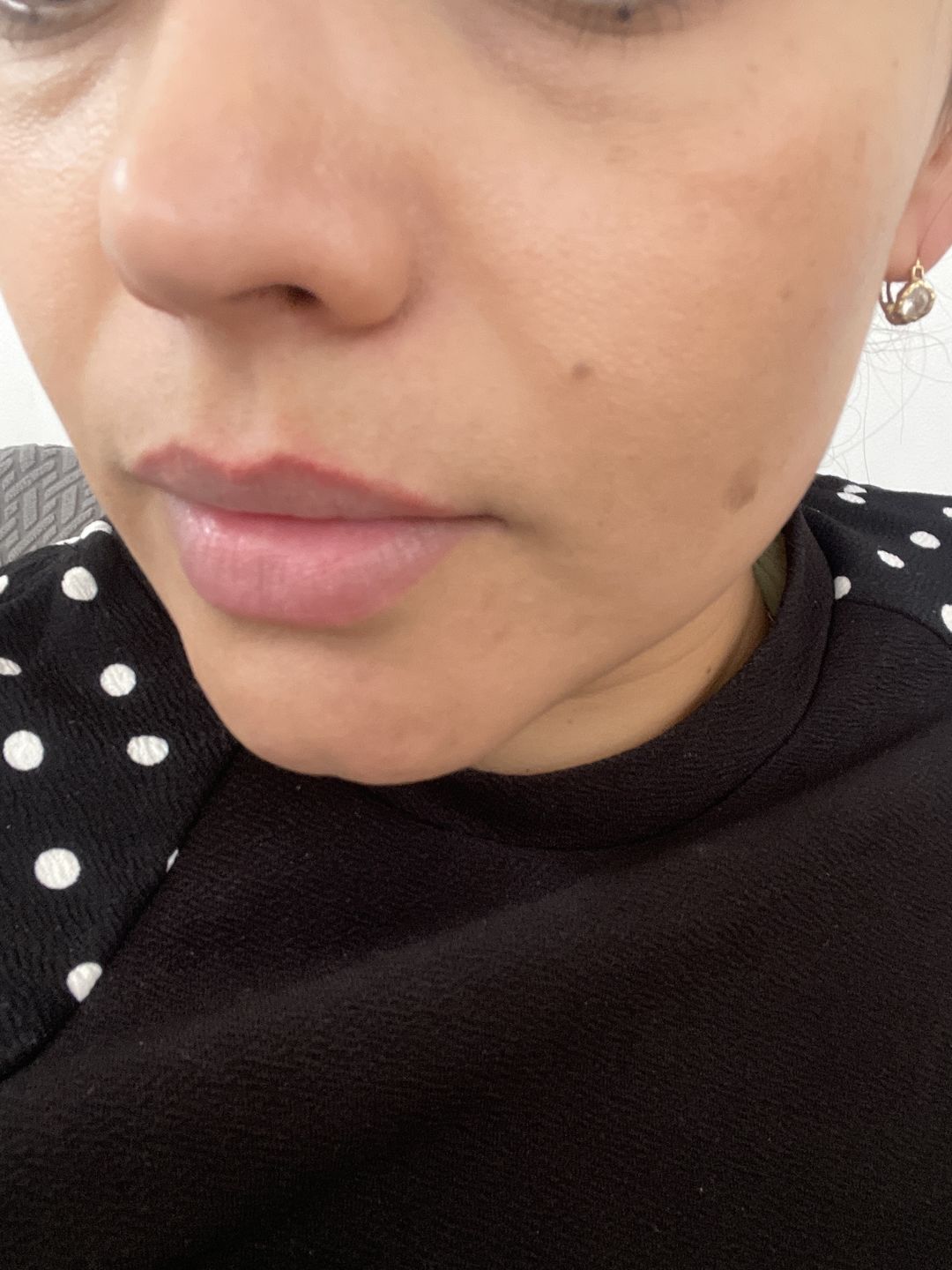 Customer photo review of Kit Rostro Perfecto (19% OFF) - Limpiador Facial 235ml + Serum de Vitamina C 30ml + Serum de Ácido Hialurónico 30ml