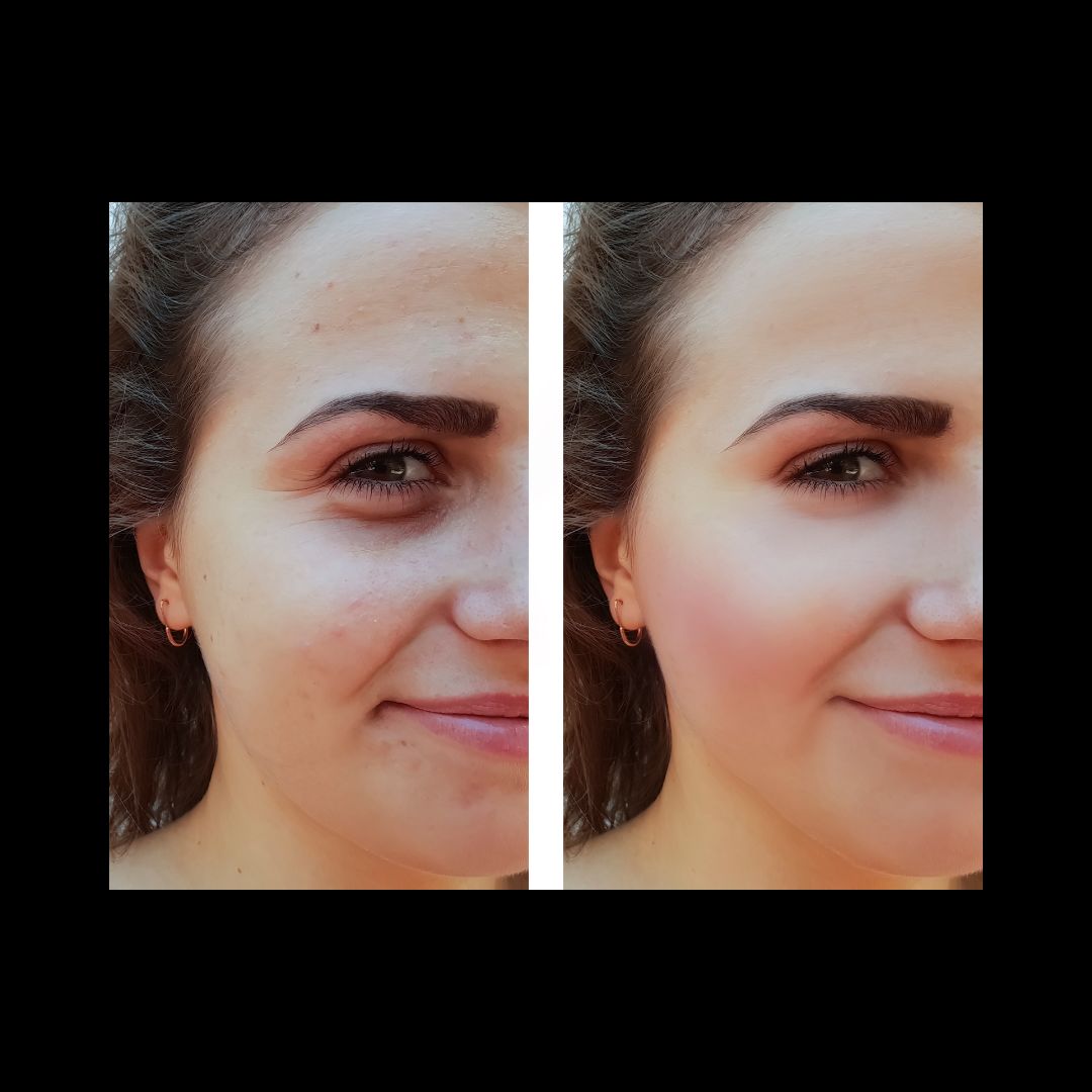 Customer photo review of Anti-Acne Serum