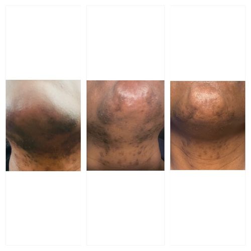 Customer photo review of Kojic Face Bundle