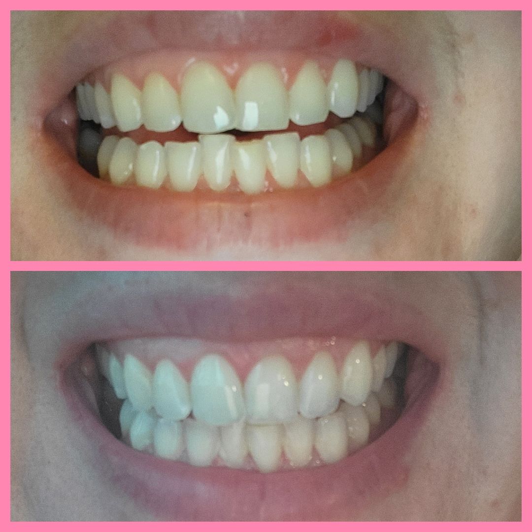 Customer photo review of Bandes Blanchissantes PAP (sans peroxyde)