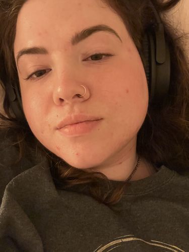 Customer photo review of SkinCeuticals Gyclolic 10 Renew Overnight