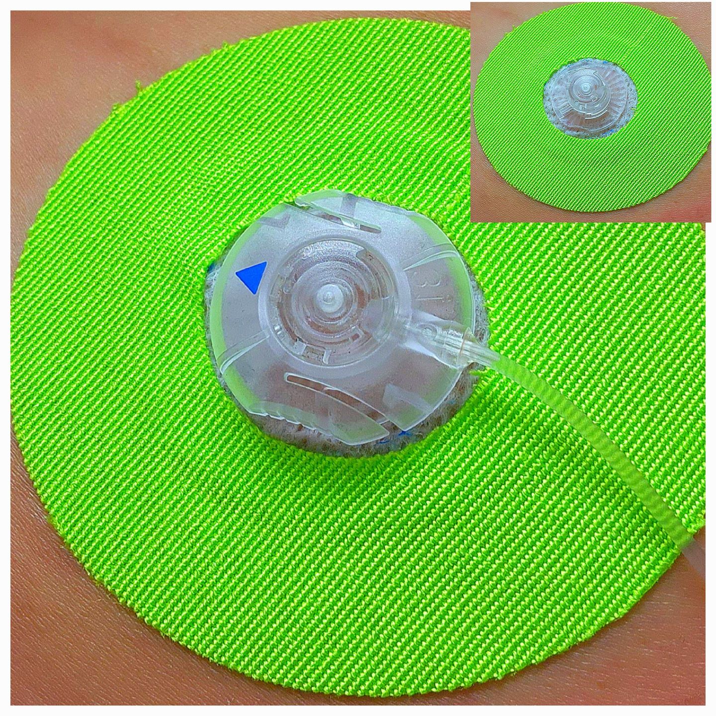 Customer photo review of Skin Grip Freestyle Libre Adhesive Patches