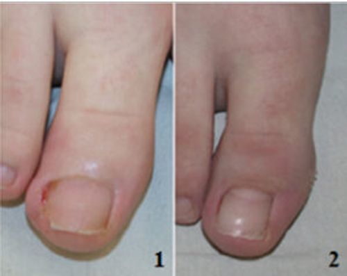 Customer photo review of German ToenailPlus™ Anti Paronychia Relief Oil