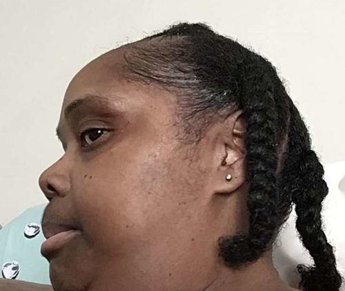 Customer photo review of ScalpRevive Minoxidil Growth Roller