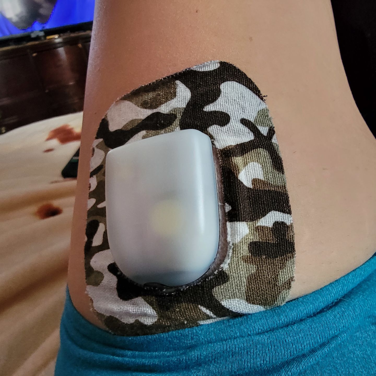 Customer photo review of Skin Grip Original - Omnipod Adhesive Patches
