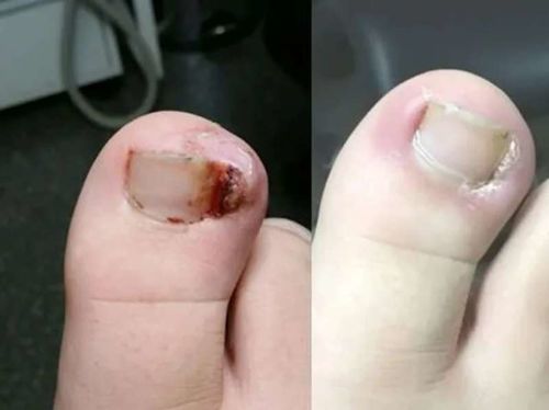 Customer photo review of German ToenailPlus™ Anti Paronychia Relief Oil