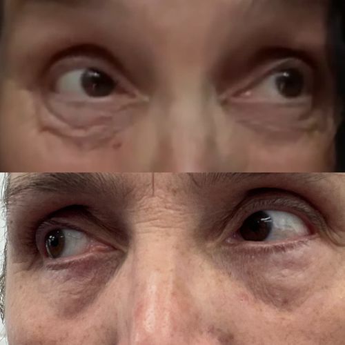 Customer photo review of 🔥Limited Time Discount 🔥 Last Day🔥OPENEYES Awaken Peptide Lifting Eye Gel