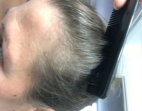 Customer photo review of ScalpRevive Minoxidil Growth Roller